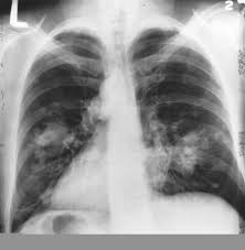 X-ray of lungs